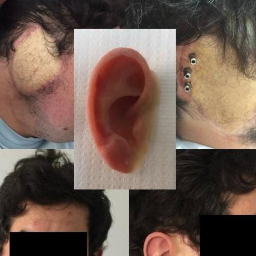 Reconstrucción de la oreja Fotos del antes y el después